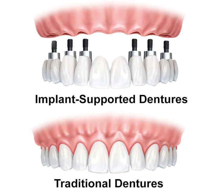 Illustration of a denture attached to dental implants, and one that sits on the gums