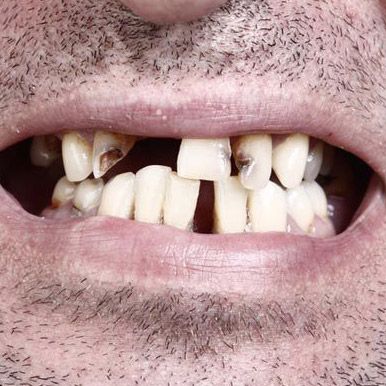 Mouth with decayed, broken teeth