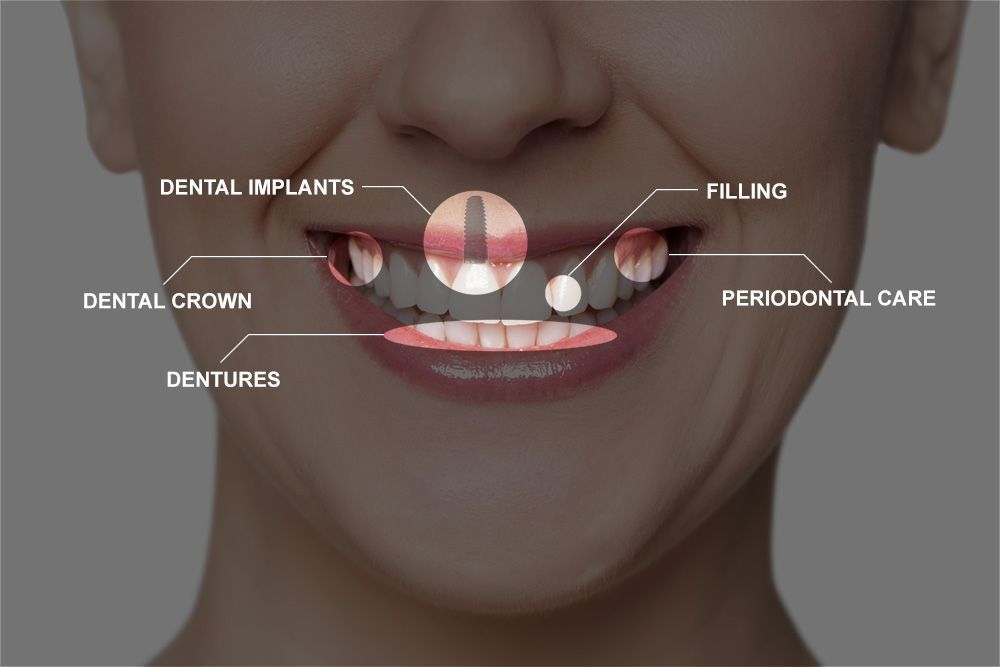 Graphic showing full mouth reconstruction procedures