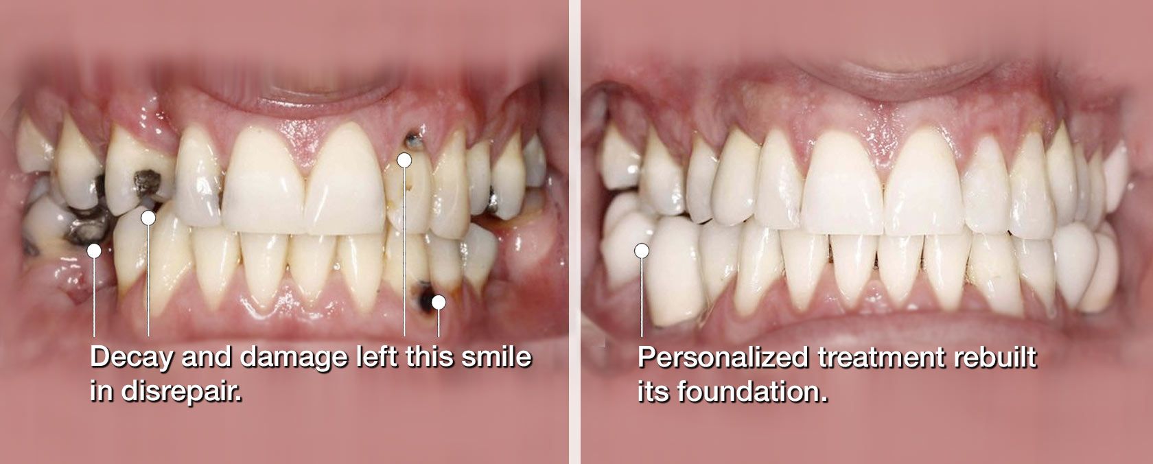before and after full mouth reconstruction