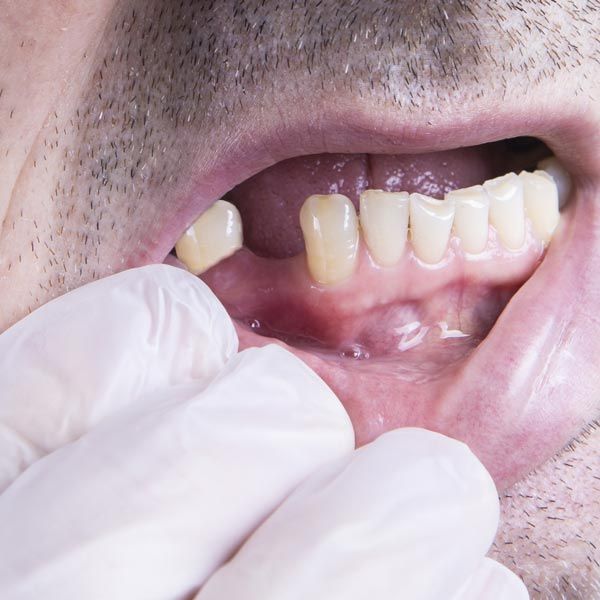 Mouth with missing tooth